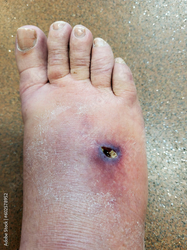 фотографія Stingray whip injury resulting in infection and tissue necrosis