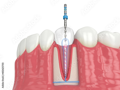 3d render of lower jaw with endodontic rotary file over white background