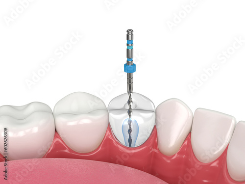 3d render of lower jaw with endodontic rotary file over white background photo