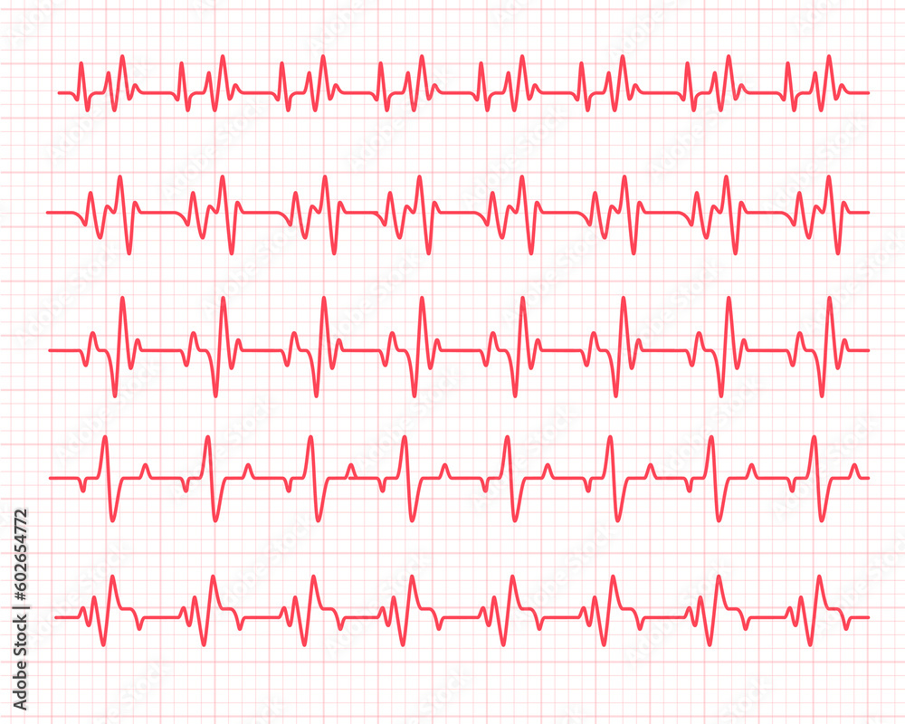 heart rhythm graph Checking your heartbeat for diagnosis