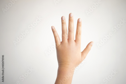 Close-up of female hand swollen from insect bites isolated on white background. Female hand that is swollen from an accident or animal bite on white background. 