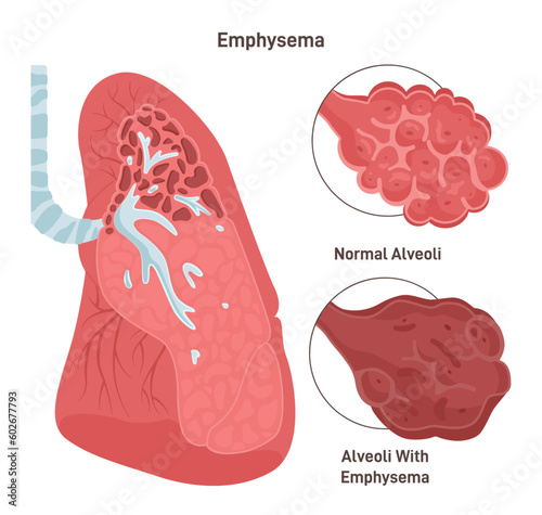 Emphysema. Chronic obstructive pulmonary disease caused by smoking.