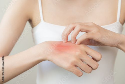 Dermatology asian young woman allergy  allergic reaction from atopic  insect bite  scratching itchy back of hand  red spot or rash of skin. Healthcare treatment of beauty. Isolated on white background
