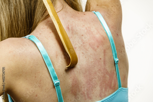 Woman scratching her itchy back using scratcher