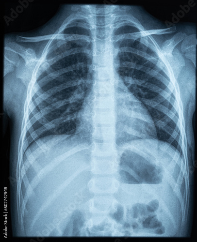 X ray photo image of chest area