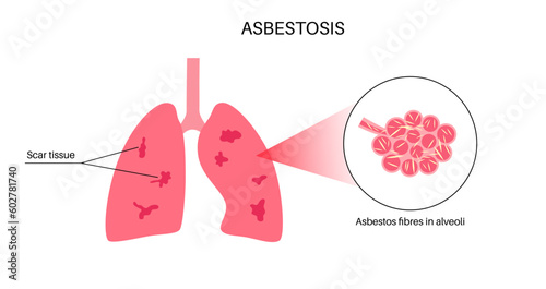 Asbestosis lung disease