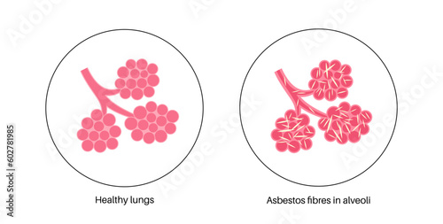 Asbestosis lung disease