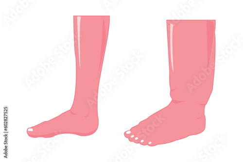normal and abnormal foot. edema foot illustration for education. eps 10