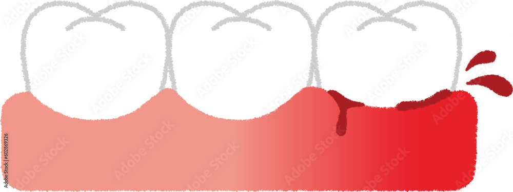 Fototapeta premium 歯肉炎のイラスト