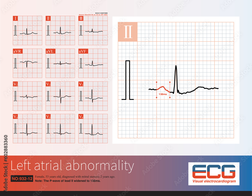 Female, 53 years old, diagnosed with mitral stenosis 2 years ago. When ...