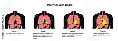 Mesothelioma cancer stages