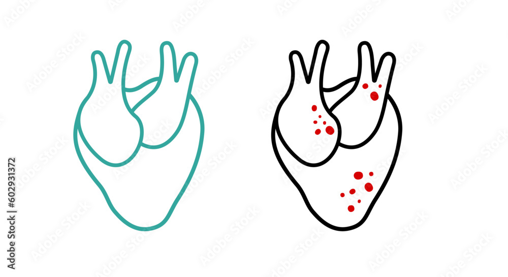 Obraz premium Healthy Heart and Ischemic Heart Disease minimalist lineart illustration. Blocked coronary artery, blood flow decreases, thrombus. Atherosclerosis. Acute Myocardial infarction. Vector flat isolated
