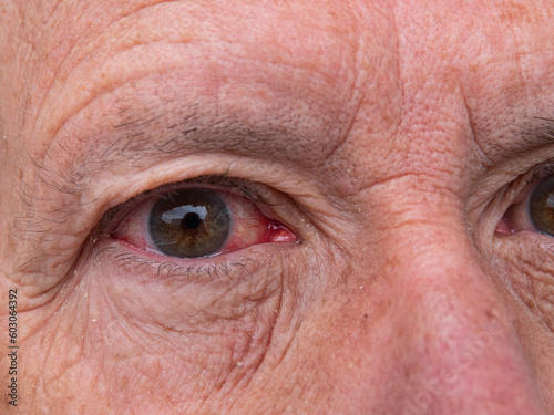 Closeup of irritated red bloodshot eye known as a hyphema - accumulation of red blood cells.
