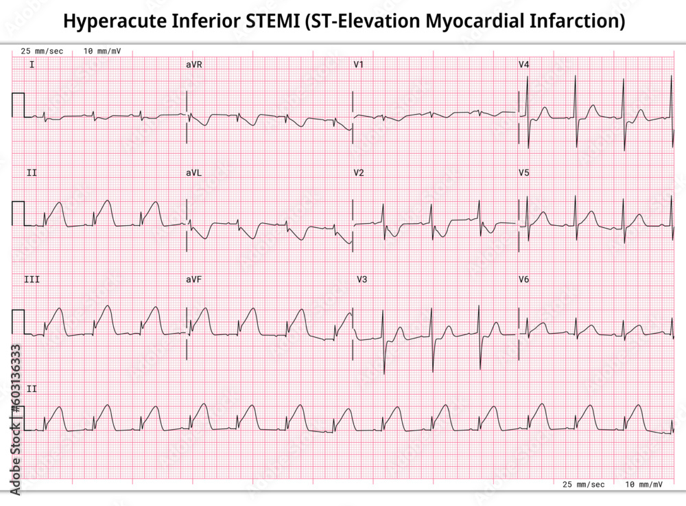 Hyperacute Inferior STEMI (ST-Elevation Myocardial Infarction) - 12 Lead ECG Common Case - 3 Sec/lead - Vectors and Illustrations for Medical Purposes Hyperacute Inferior STEMI (ST-Elevation Myocardial Infarction) - 12 Lead ECG Common Case - 3 Sec/lead - Vectors and Illustrations for Medical Purposes