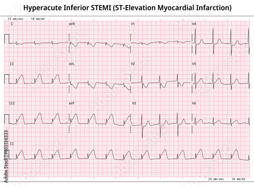 Hyperacute Inferior STEMI (ST-Elevation Myocardial Infarction) - 12 Lead ECG Common Case - 3 Sec/lead - Vectors and Illustrations for Medical Purposes