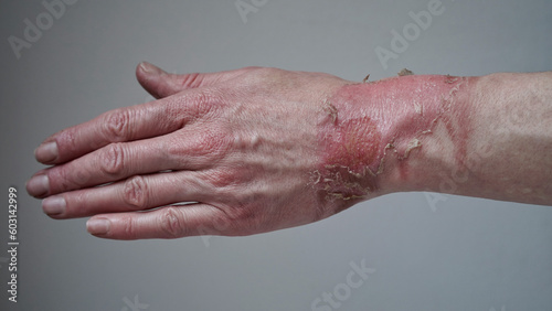 Close-up of a woman's hand with a burst blister from a boiled water burn, broken skin, 1st or 2nd degree burn. Painful wound. Thermal burn. Skin peels off after a burn, wound treatment. macro photo