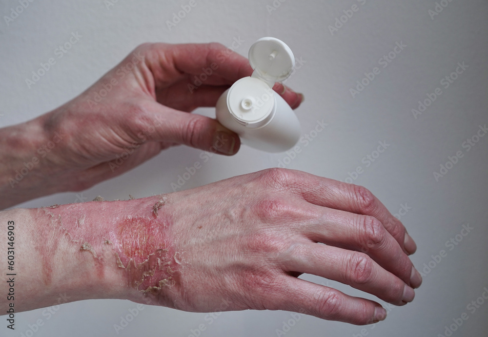 mockup bottle with cream healing ointment woman hand burned with