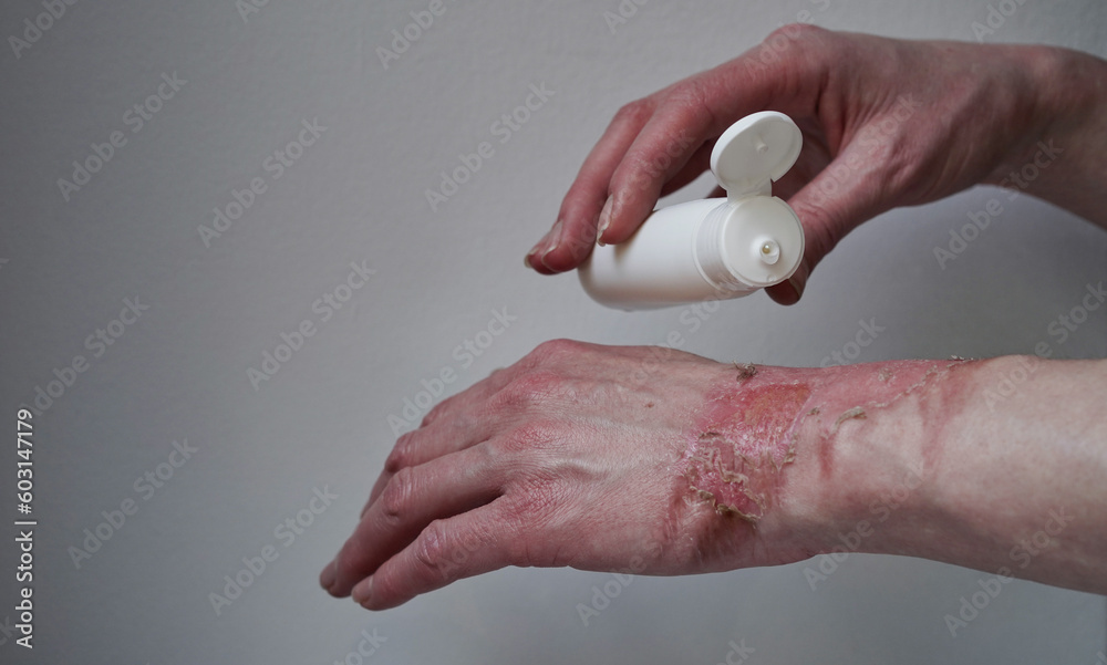 mockup bottle with cream healing ointment woman hand burned with