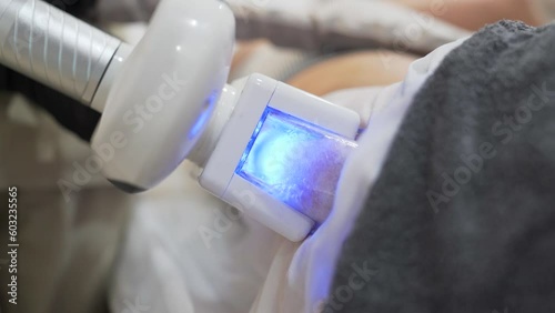Woman receiving cryolipolysis treatment on abdomen cartridges for fat reduction. Close up, photo