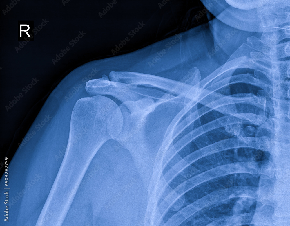 X-ray image of shoulder pain, shoulder ligament tendinitis, shoulder ...