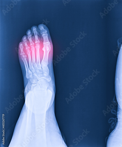 Foot and ankle pain on x-ray, isolated on black background