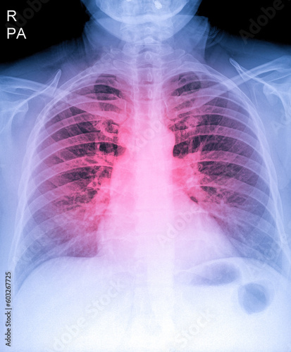 X-Ray Image Of Human Chest for a medical diagnosis  shows pain area with red. Thorax x-ray for lungs examination  PA up right