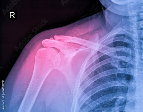 X-ray image of shoulder pain, shoulder ligament tendinitis, shoulder muscle strain