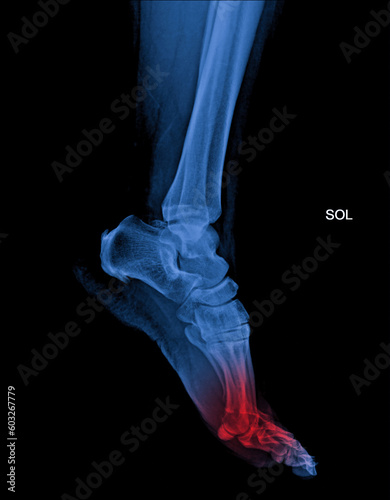 Foot and ankle pain on x-ray, isolated on black background
