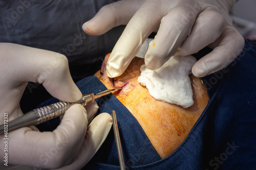 Tableau sur toile A cosmetic surgeon makes an incision at the alar crease of the nose
