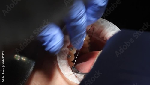 orthodontist using dental tools while cleaning teeth of patient wearing brackets photo