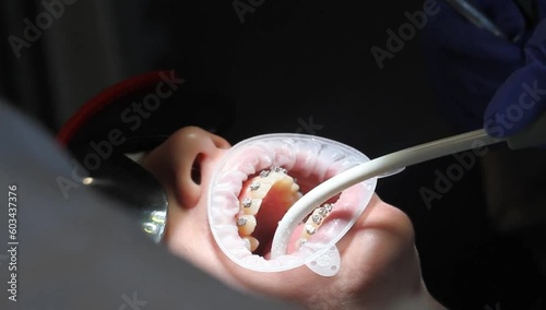 orthodontist using dental tools while cleaning teeth of patient wearing brackets photo