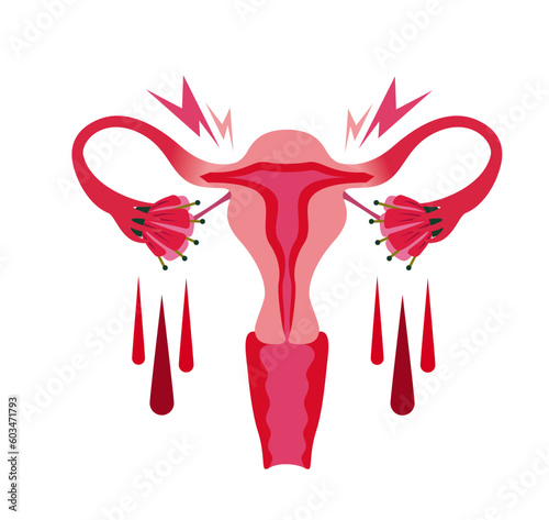 Vector illustration on a white background of endometriosis. With blood, cramps and pain. 