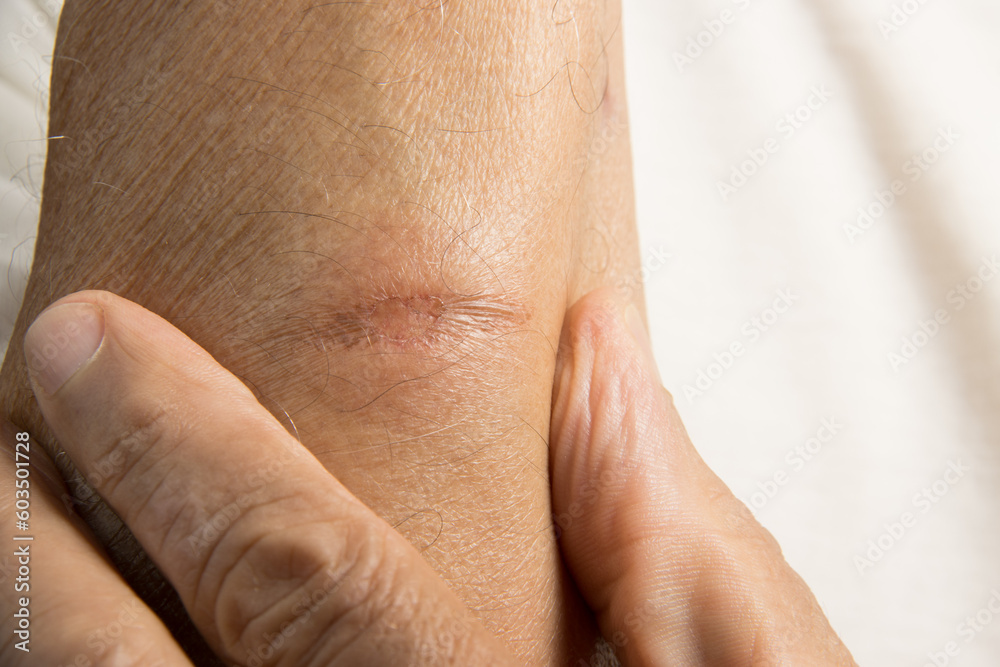 Man with a small minor first degree burn on his forearm Man with a small minor first degree burn on his forearm