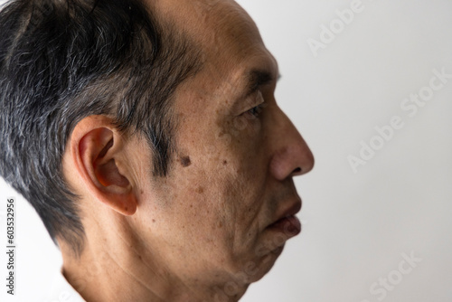 大きなシミがある日本人中年男性の横顔 より