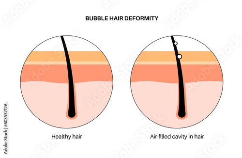 Bubble hair deformity