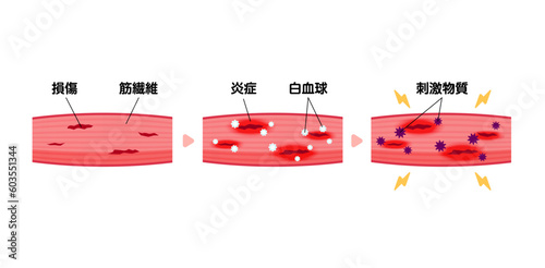筋肉痛の発生メカニズム・人体の仕組み・ベクターイラスト