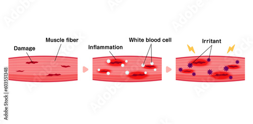 Mechanism of muscle soreness vector illustration