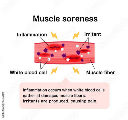 Mechanism of muscle soreness vector illustration