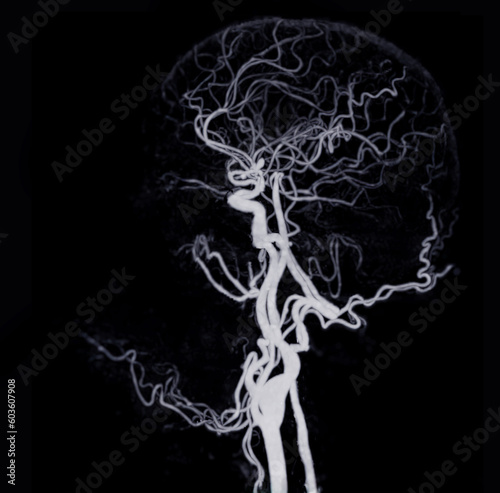 CT angiography of the brain or CTA brain showing Cerebral aryery.