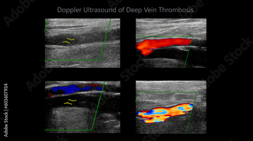 Color Doppler ultrasound determination in deep vein thrombosis patients for finding  deep vein thrombosis of lower extremity. photo
