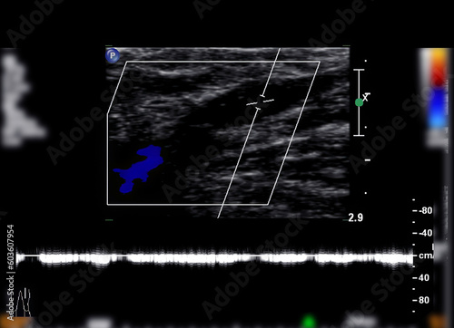 фотографія Color Doppler ultrasound determination in deep vein thrombosis patients for finding  deep vein thrombosis of lower extremity
