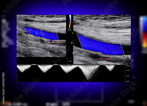 A carotid artery Doppler ultrasound is a diagnostic test used to check the arteries in the neck for diagnosis  any blockage in the veins by a blood clot or “thrombus” formation. photo