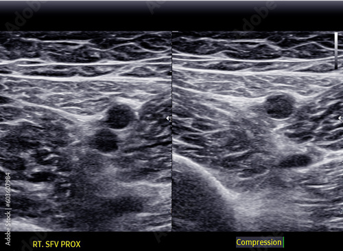 A carotid artery Doppler ultrasound is a diagnostic test used to check the arteries in the neck for diagnosis  any blockage in the veins by a blood clot or “thrombus” formation. photo