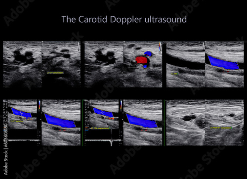 Canvas Print A carotid artery Doppler ultrasound is a diagnostic test used to check the arteries in the neck for diagnosis  any blockage in the veins by a blood clot or “thrombus” formation