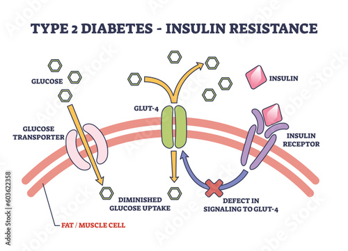 Type 2 diabetes and insulin resistance anatomical explanation outline diagram. Labeled medical science representation with insulin receptor, GLUT defect and diminished uptake vector illustration. photo