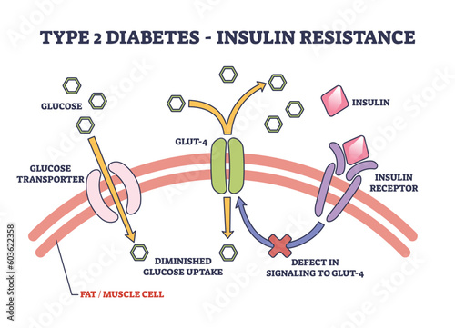 Type 2 diabetes and insulin resistance anatomical explanation outline diagram. Labeled medical science representation with insulin receptor, GLUT defect and diminished uptake vector illustration.