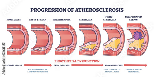 Progression of atherosclerosis and thrombosis formation outline diagram. Labeled educational medical stages with endothelial dysfunction development to vein complicated lesion vector illustration. photo