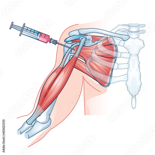 Stem cell therapy as regenerative medicine for tissue repair outline diagram. Educational example with treatment and injection to help diseased, dysfunctional or injured tissues vector illustration.