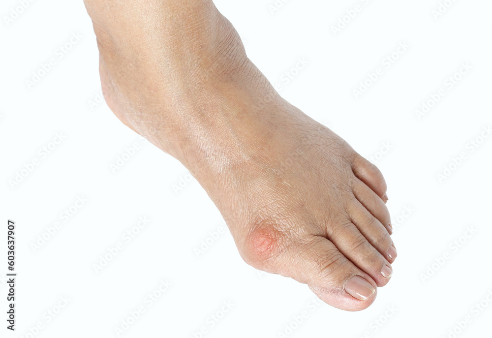 Closeup inflammation of deform bunion joint in big toe bone. Hallux valgus, bunion in foot isolated on white background. Closeup inflammation of deform bunion joint in big toe bone. Hallux valgus, bunion in foot isolated on white background.