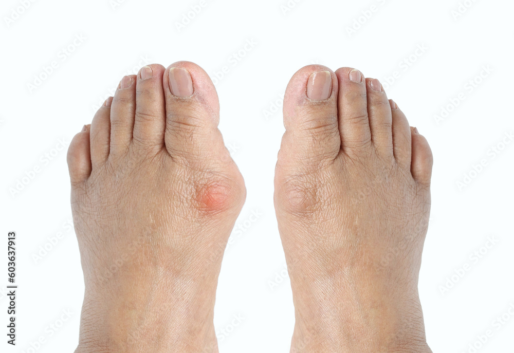 Closeup inflammation of deform bunion joint in big toe bone. Hallux valgus, bunion in female foot compare with typical foot isolated on white background. Closeup inflammation of deform bunion joint in big toe bone. Hallux valgus, bunion in female foot compare with typical foot isolated on white background.